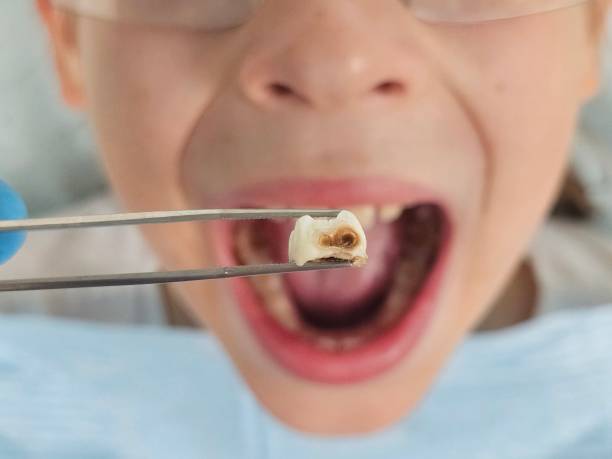 Best Dental Abscess Treatment in Newburgh, IN